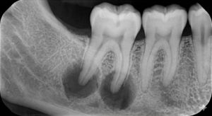 Dental X-ray showing infected tooth root